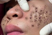 How to Get Rid of Blackheads